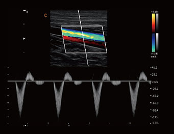 血管， PW 模式