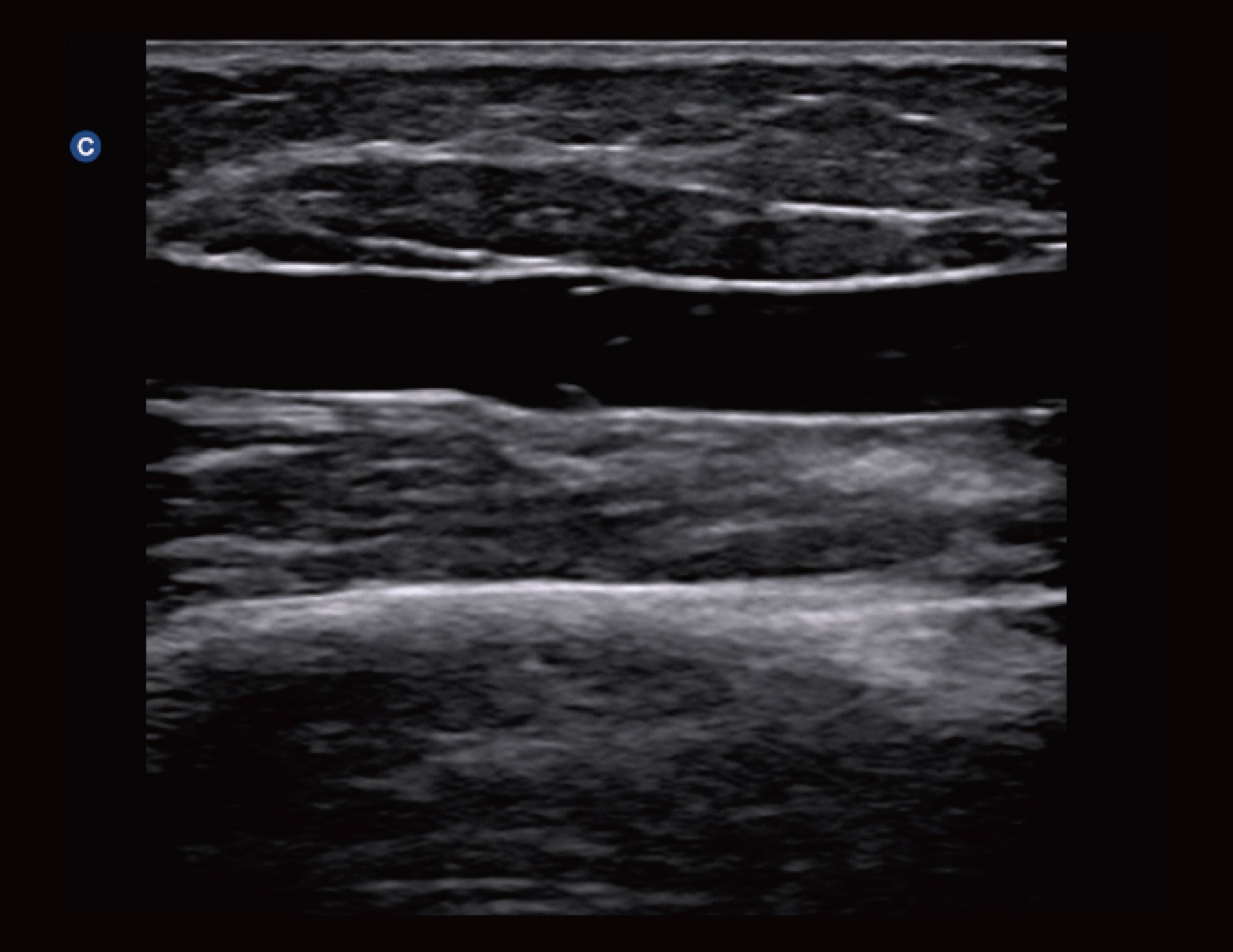 静脉瓣，B模式