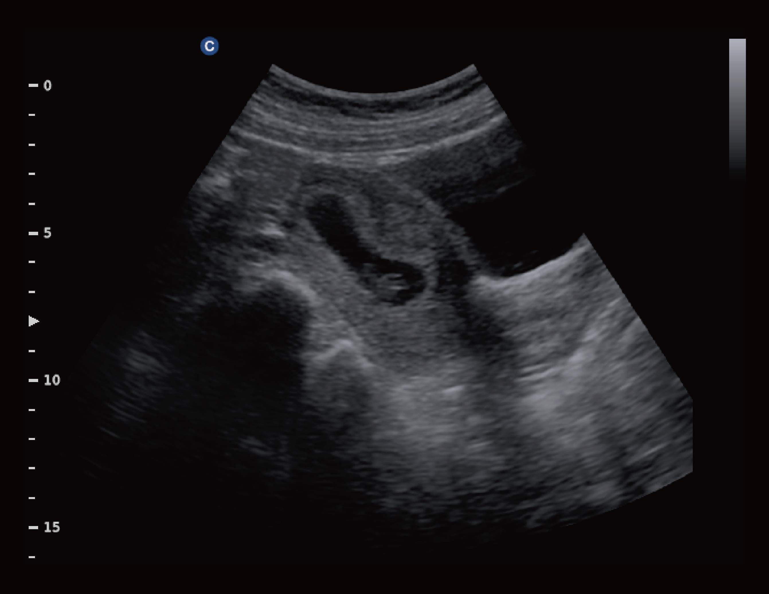 早孕，B模式