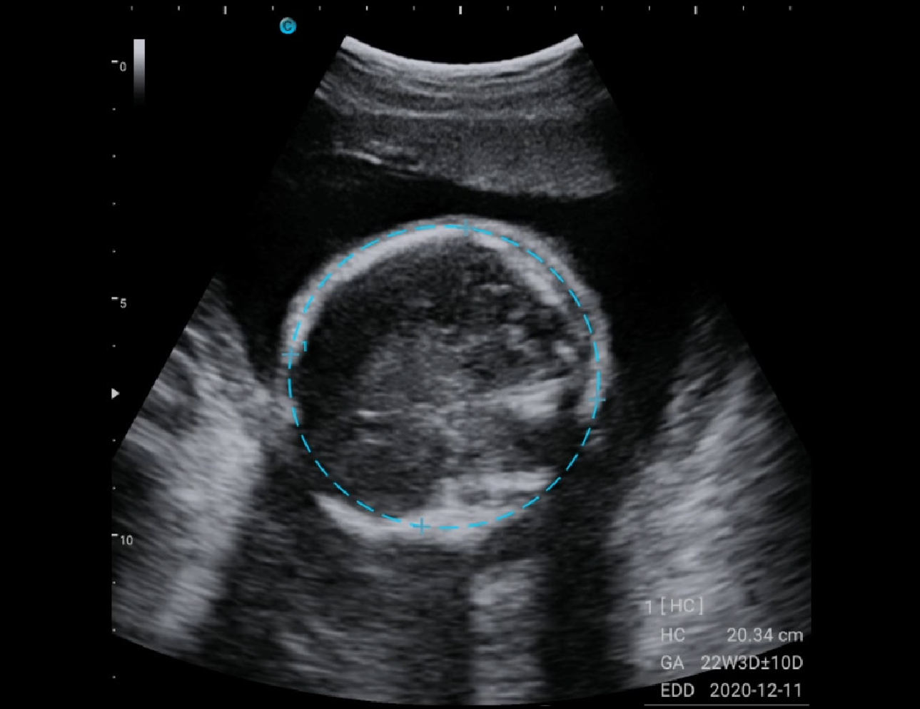 胎儿头部，B 模式