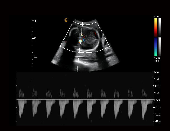 胎儿大脑中动脉，C模式