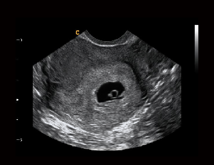 孕囊，B模式