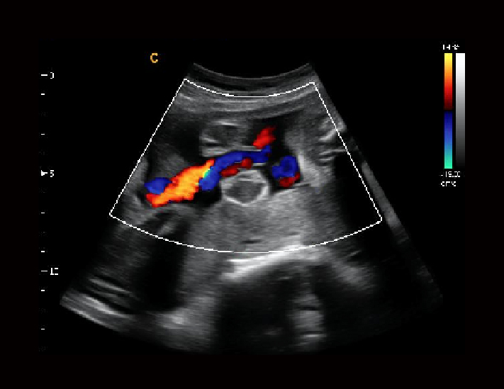 胎儿脐带，C模式