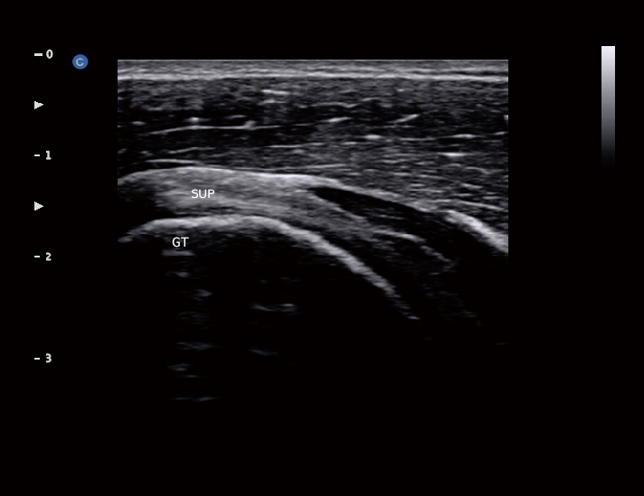 肌骨，B模式