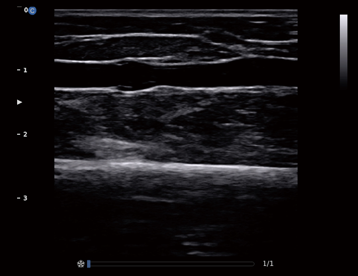 浅表血管，B模式