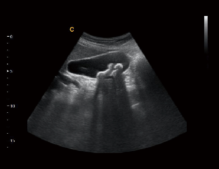 胆囊结石，B模式